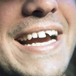 Broken Teeth