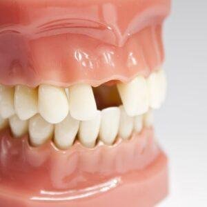 Missing Teeth