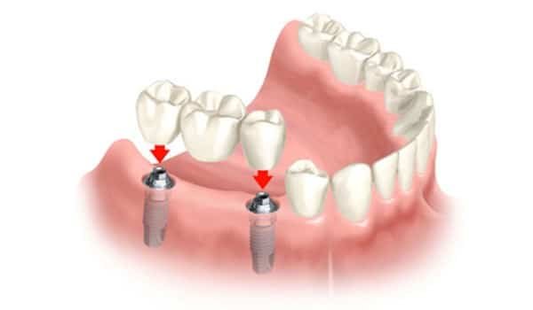 Back Teeth Replacement Back Teeth Replacement