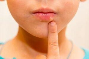 Canker Sores Richmond Hill