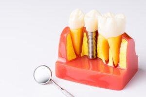 Dental Implant
