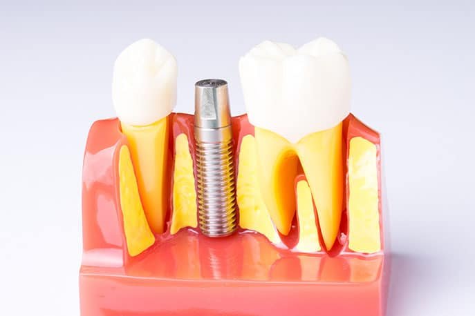 Dental Implant Surgery Dental Implant Surgery