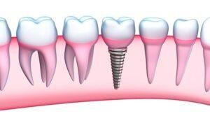 Dental Implants Teenagers
