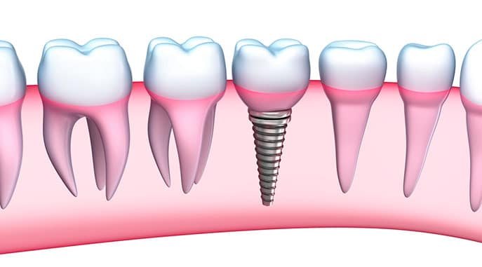 Dental Implants Teenagers