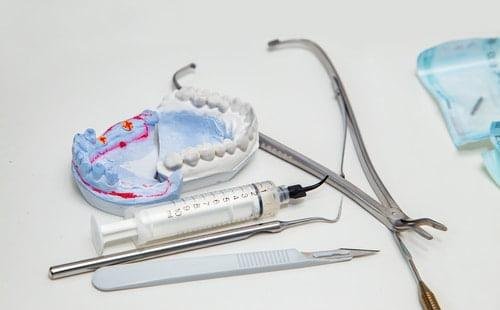 Dental Implants vs. Bridgework