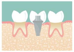 Types of Dental Implants