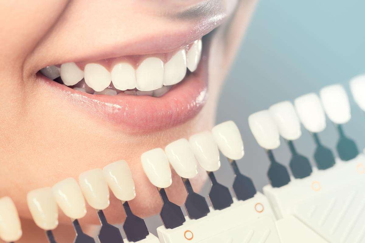 teeth whitening