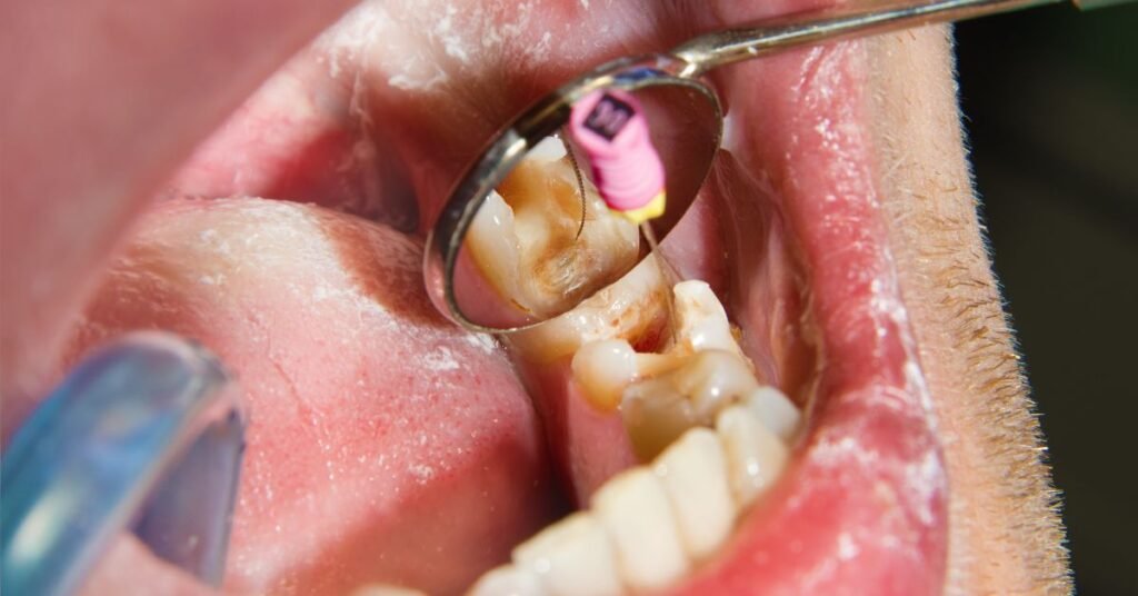 best-dentist-for-root-canal-near-me