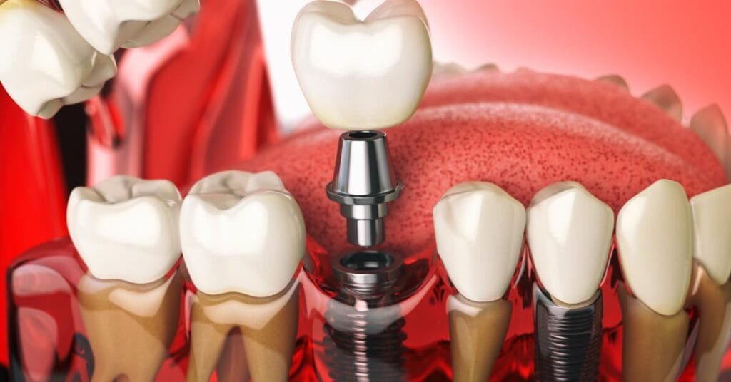 full mouth dental implants