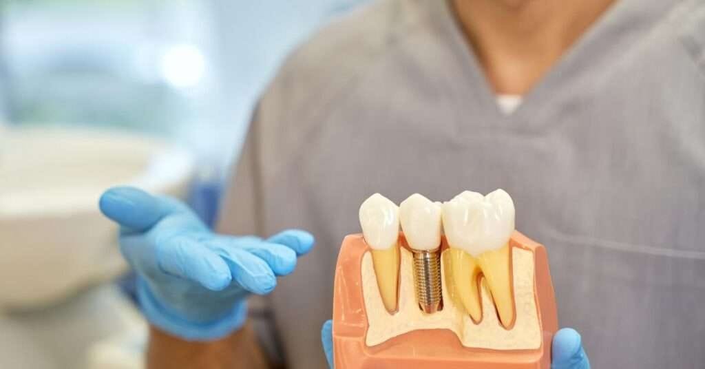full mouth dental implants