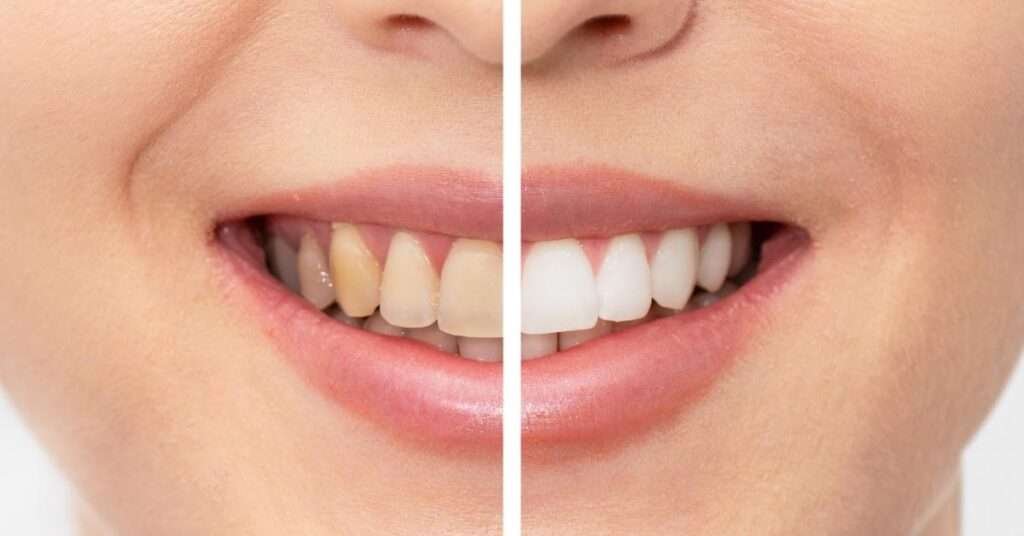 teeth whitening richmond bc