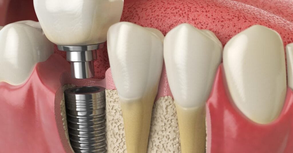 full mouth dental implants