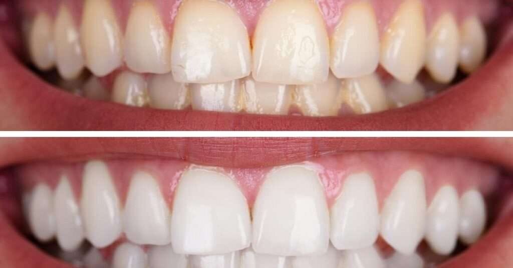 teeth whitening richmond bc