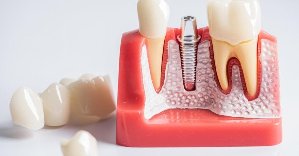 full mouth dental implants