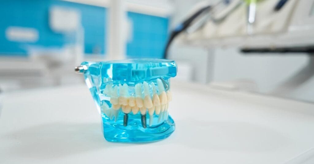 full mouth dental implants