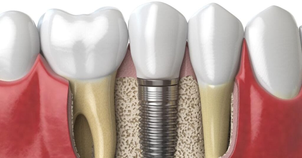 full mouth dental implants