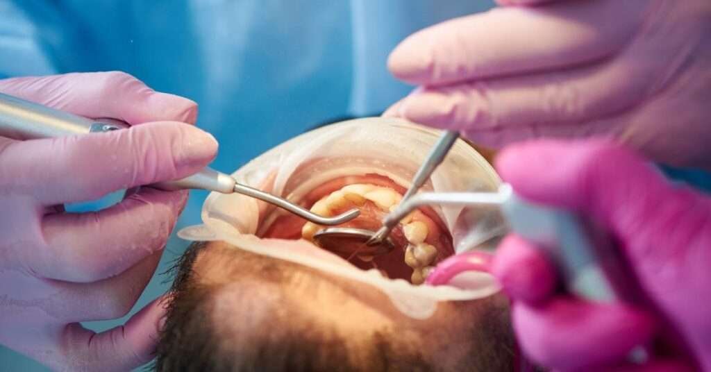 full mouth dental implants