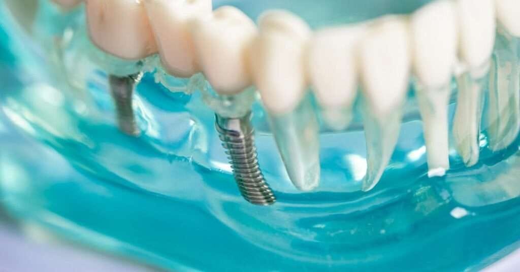 full mouth dental implants