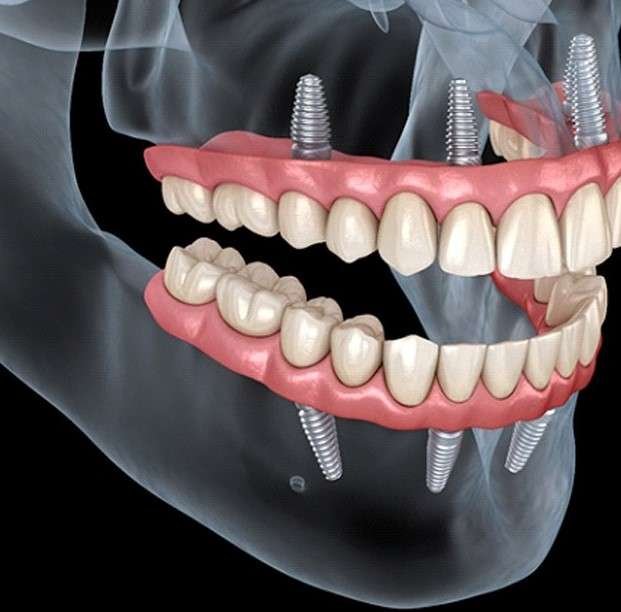 All on 4 Dental Implants