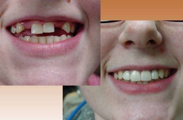 Mini dental implants