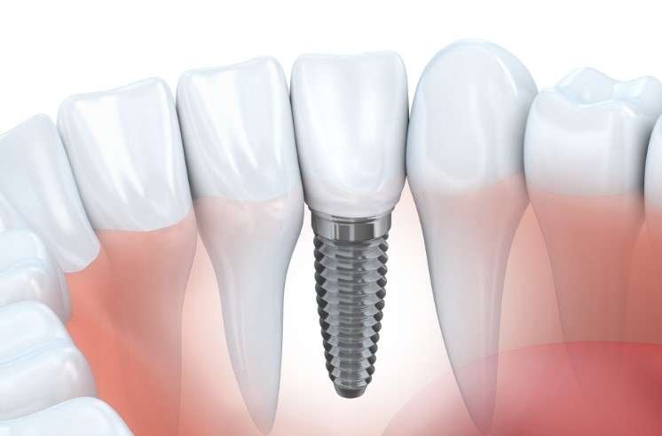 how long does a root canal last