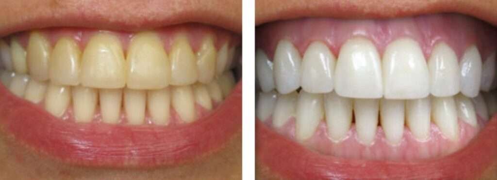 how much does teeth whitening cost