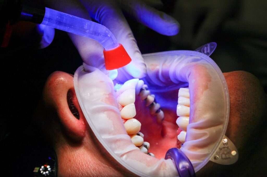 how much is a dental filling without insurance