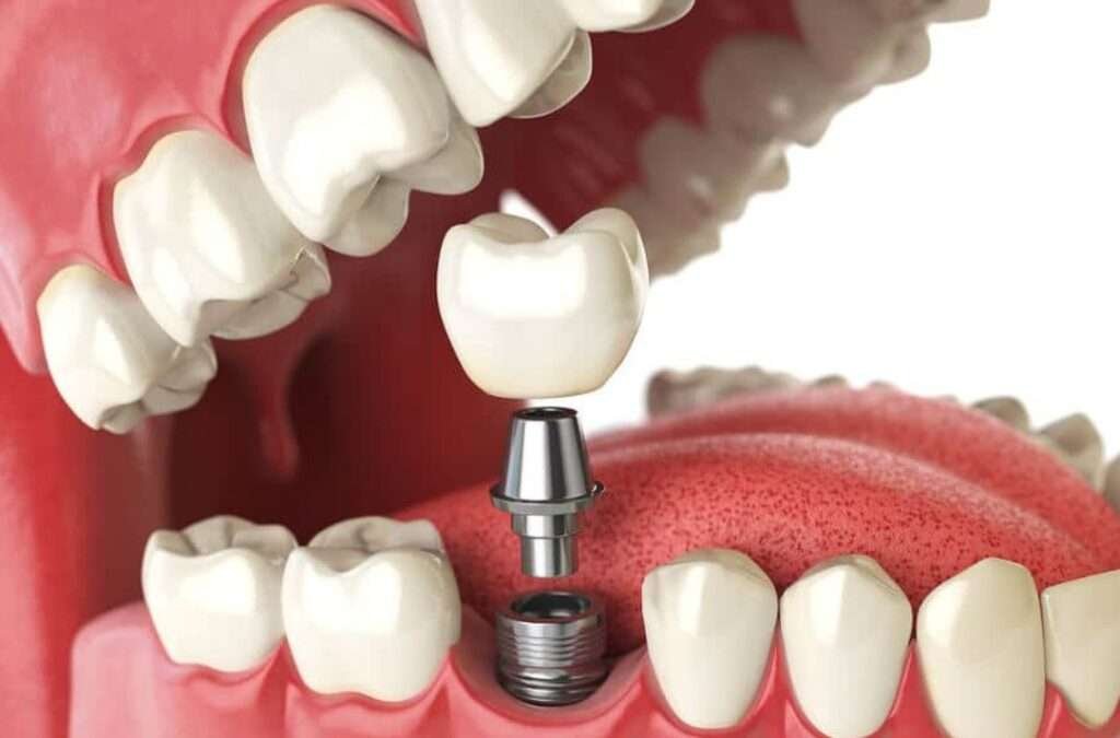 mini-dental-implants