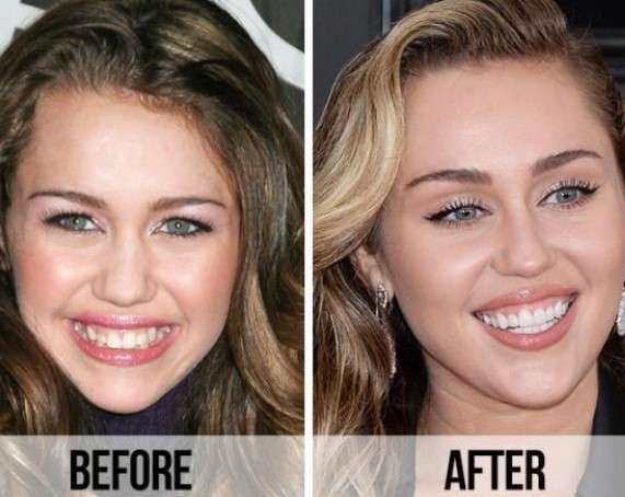 celebrity before and after dentures