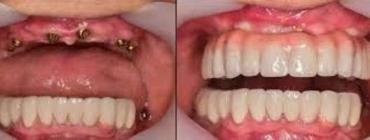 upper denture implants