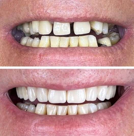 veneers vs dentures