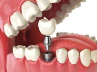 why no dairy after dental implant