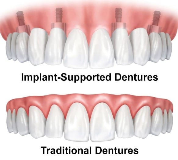 Types of Partial Dentures