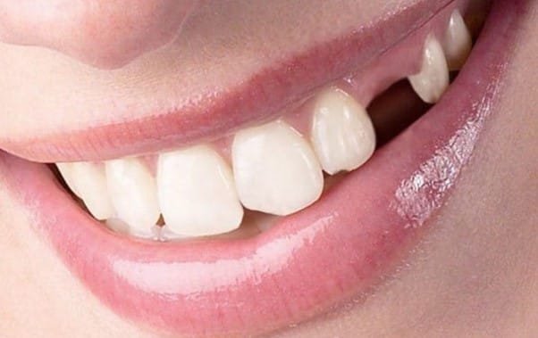 single tooth partial denture