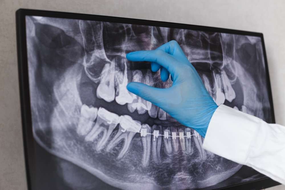 root canal cost ontario