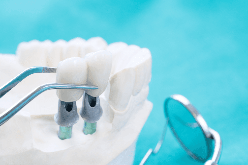 dental implant cost