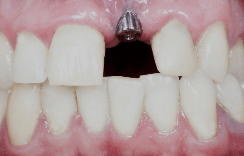 root canal