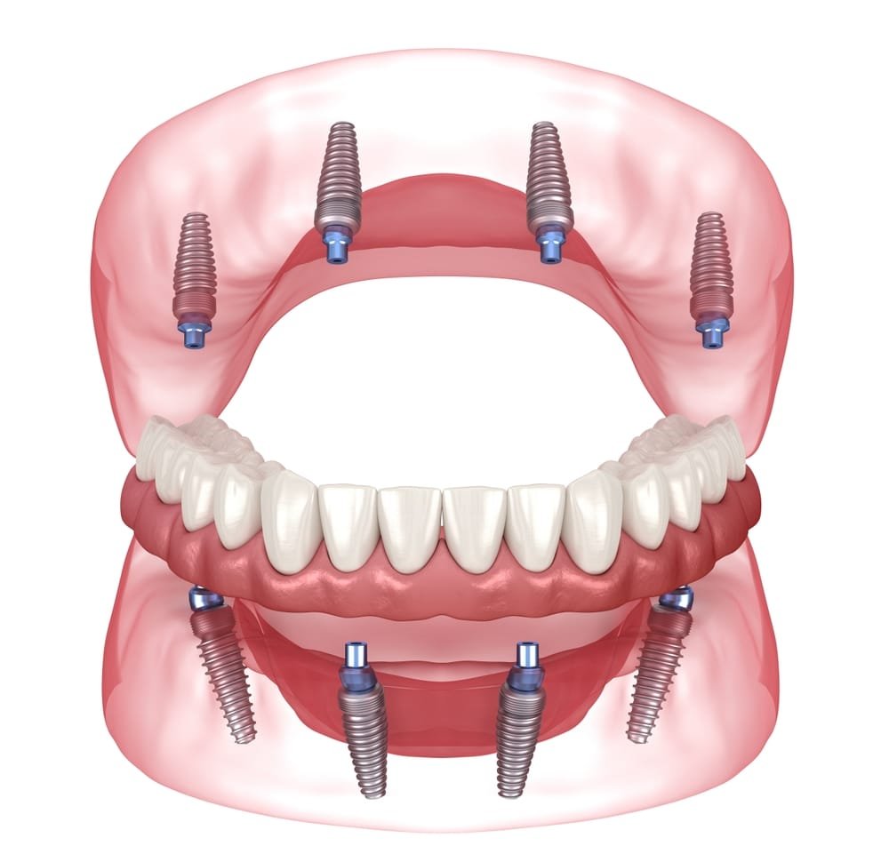 all on four dental implants