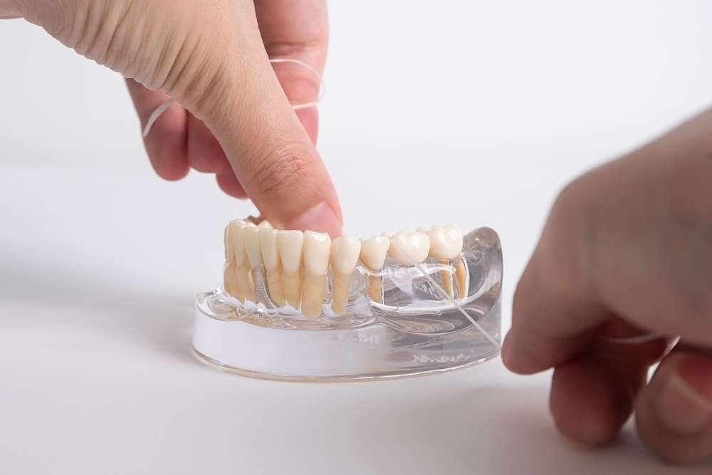 dental bridge vs implant