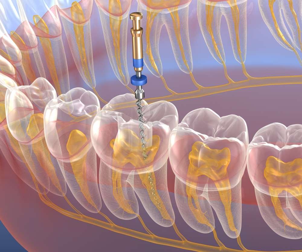 how much is a root canal