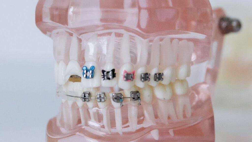 Dental crown and porcelain veneer comparison at a dental clinic in Richmond Hill