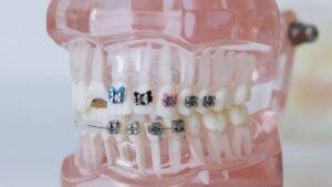 Dental crown and porcelain veneer comparison at a dental clinic in Richmond Hill