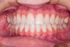 Bright smile with dental veneers in Richmond Hill